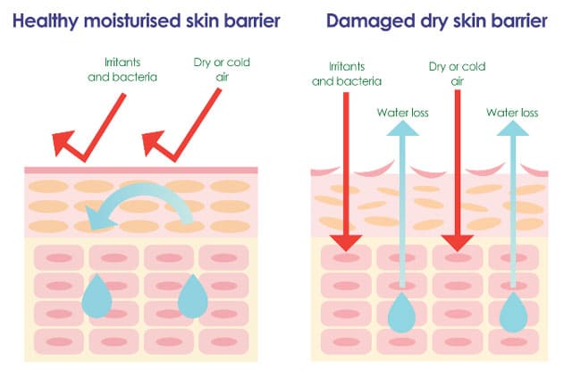 Causes of skin barrier damage